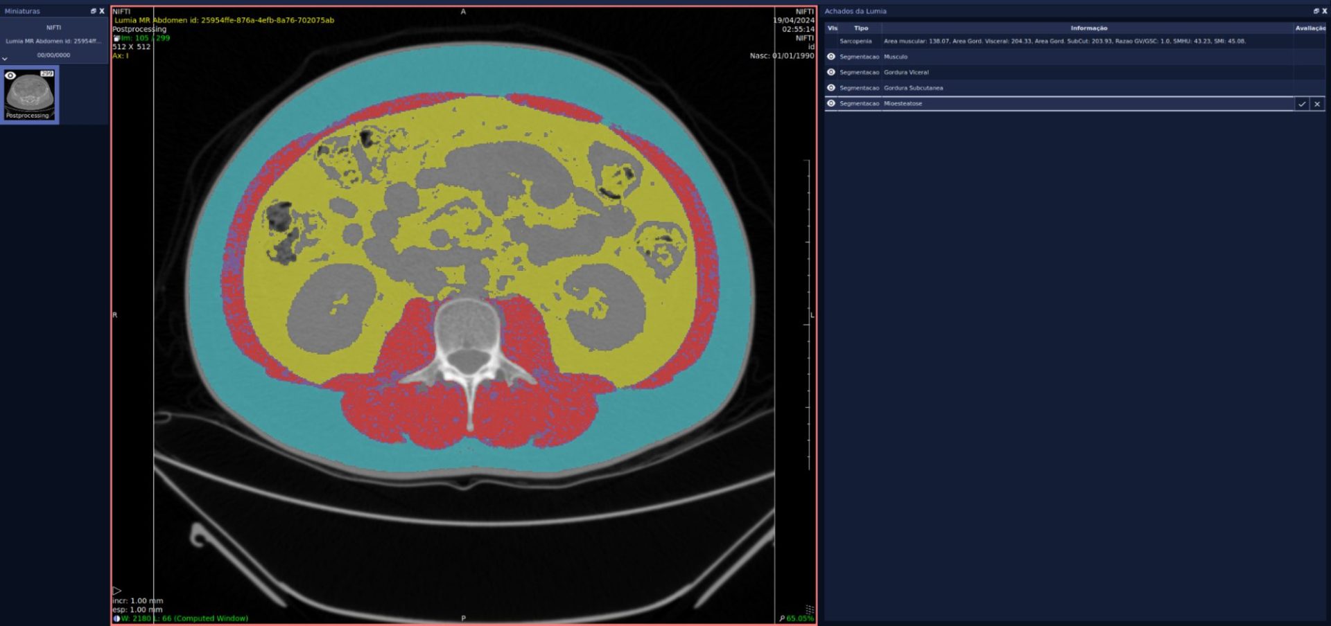 radiologia e diagnóstico por imagem, Inteligência Artificial no Diagnóstico por Imagem: como a IA auxilia os radiologistas?