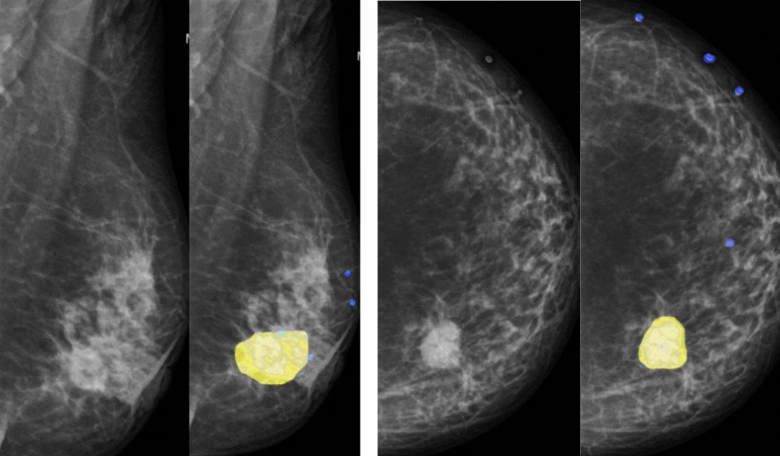 radiologia e diagnóstico por imagem, Inteligência Artificial no Diagnóstico por Imagem: como a IA auxilia os radiologistas?