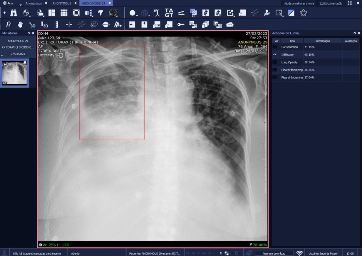 radiologia e diagnóstico por imagem, Inteligência Artificial no Diagnóstico por Imagem: como a IA auxilia os radiologistas?